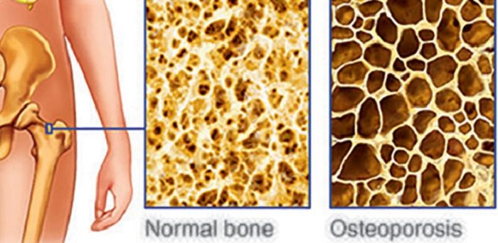 Detail Gambar Kelainan Tulang Osteoporosis Nomer 15