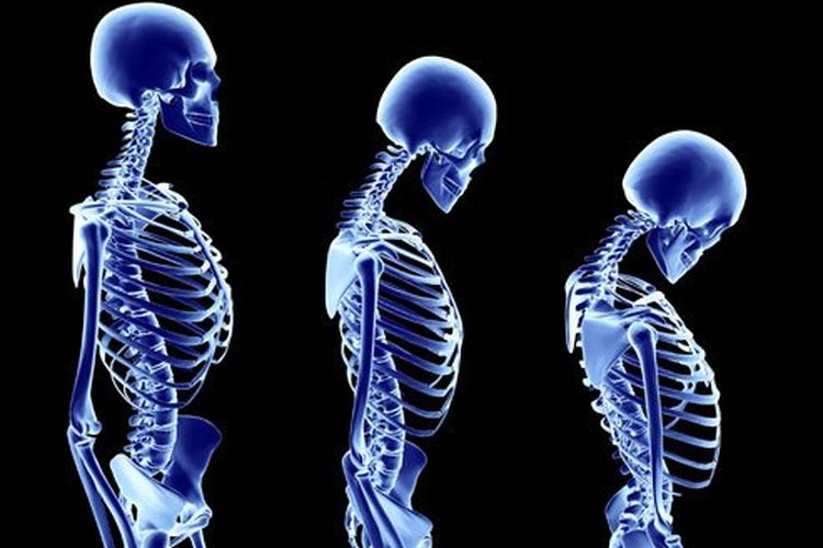 Detail Gambar Kelainan Tulang Osteoporosis Nomer 19