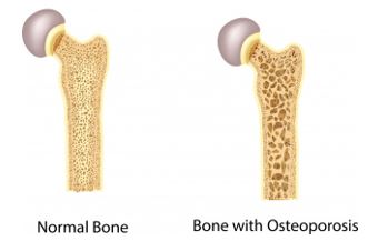 Detail Gambar Kelainan Tulang Osteoporosis Nomer 23