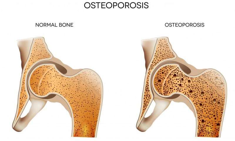 Detail Gambar Kelainan Tulang Osteoporosis Nomer 25