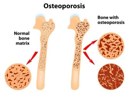 Detail Gambar Kelainan Tulang Osteoporosis Nomer 4