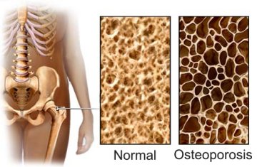 Detail Gambar Kelainan Tulang Osteoporosis Nomer 27