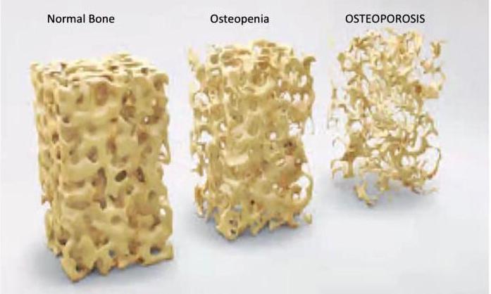 Detail Gambar Kelainan Tulang Osteoporosis Nomer 36