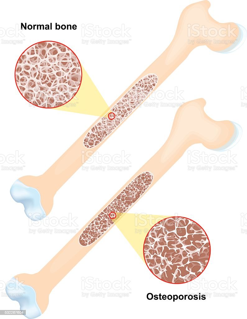 Detail Gambar Kelainan Tulang Osteoporosis Nomer 43