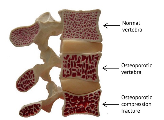 Detail Gambar Kelainan Tulang Osteoporosis Nomer 49