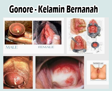 Gambar Kemaluan Terkena Spilis - KibrisPDR