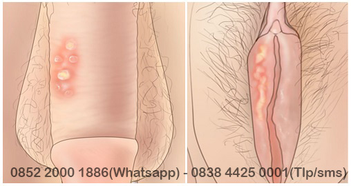 Detail Gambar Kemaluan Terkena Spilis Nomer 53