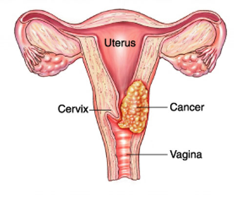 Detail Gambar Kemaluan Wanita Yang Terkena Kanker Serviks Nomer 22