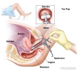 Detail Gambar Kemaluan Wanita Yang Terkena Kanker Serviks Nomer 43