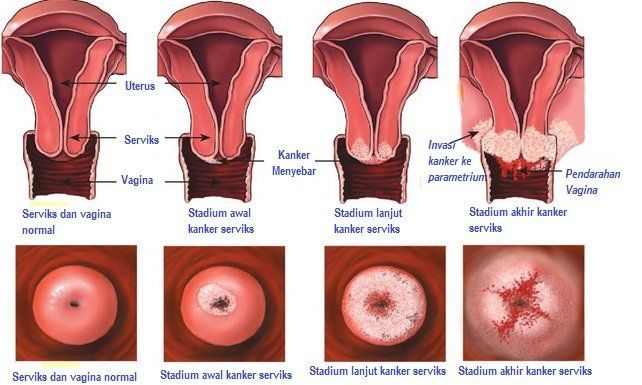 Detail Gambar Kemaluan Wanita Yang Terkena Kanker Serviks Nomer 6