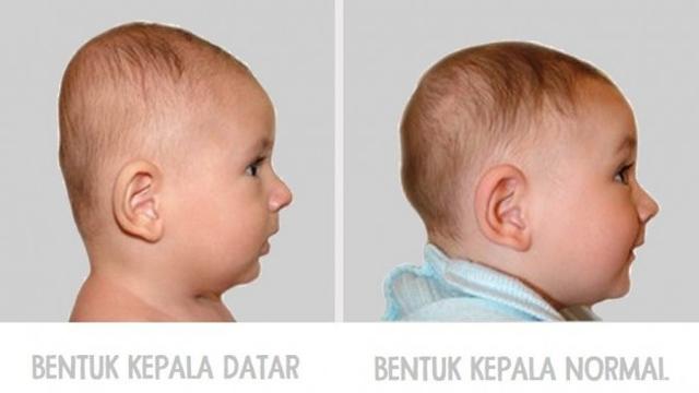 Detail Gambar Kepala Bayi Normal Nomer 2