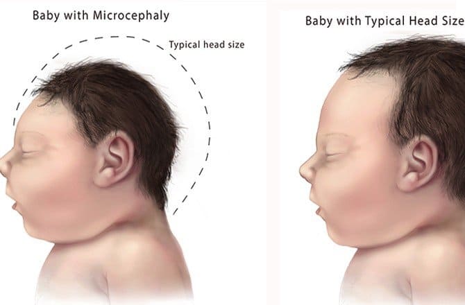 Detail Gambar Kepala Bayi Normal Nomer 11