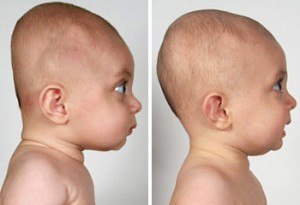 Detail Gambar Kepala Bayi Normal Nomer 21