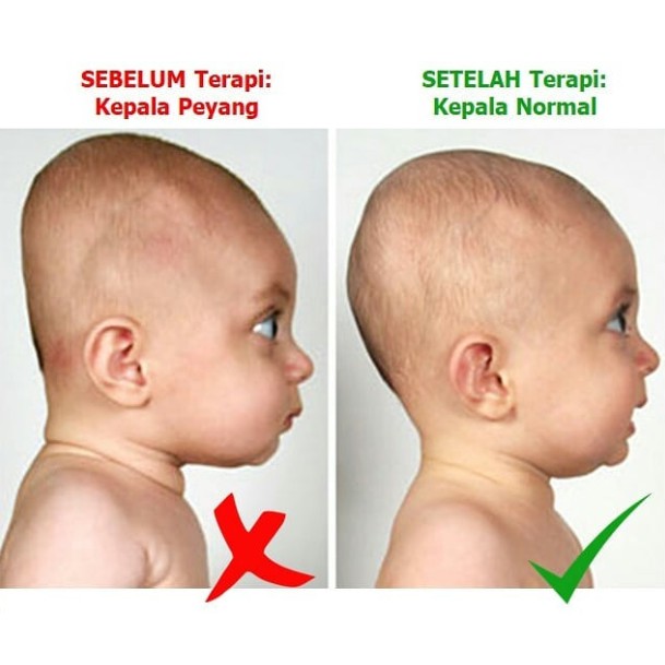 Detail Gambar Kepala Bayi Normal Nomer 22