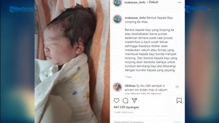 Detail Gambar Kepala Bayi Normal Nomer 44