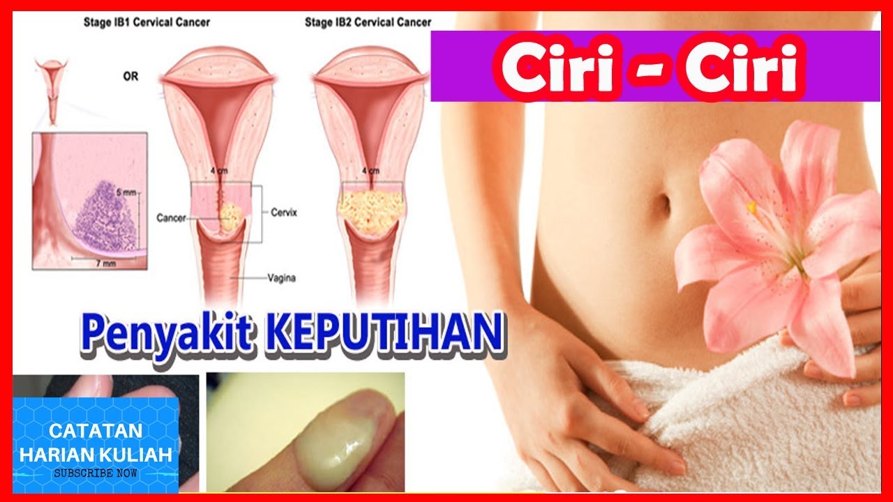 Detail Gambar Keputihan Normal Nomer 22