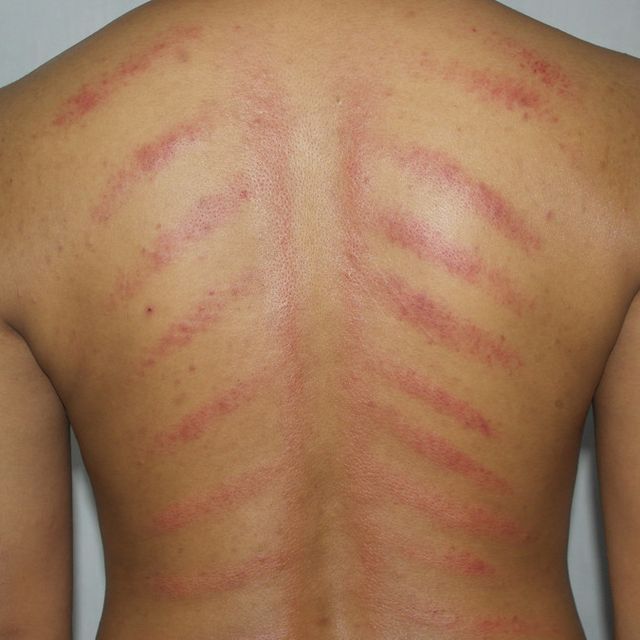 Detail Gambar Kerokan Badan Nomer 9