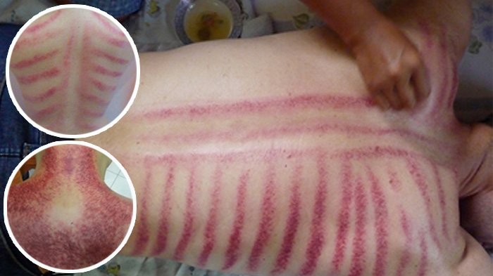 Detail Gambar Kerokan Badan Nomer 13