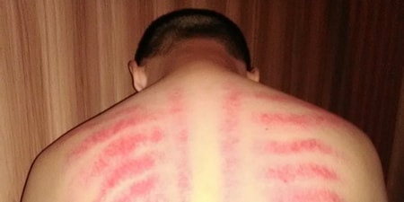 Detail Gambar Kerokan Badan Nomer 14