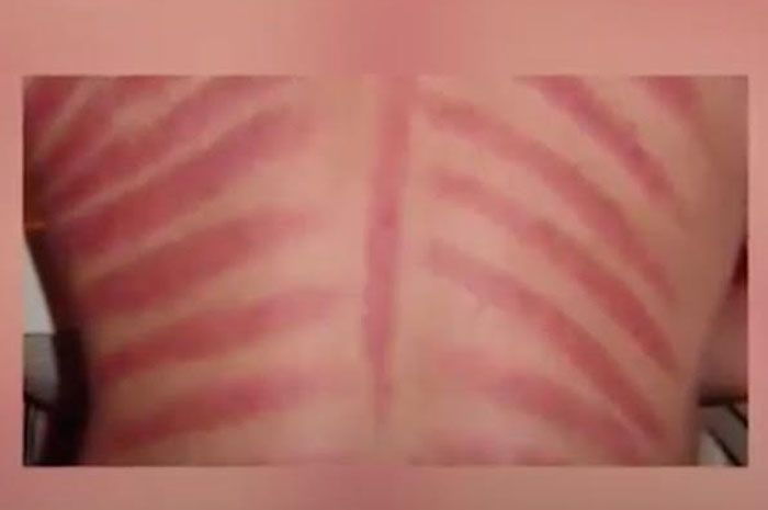 Detail Gambar Kerokan Badan Nomer 15