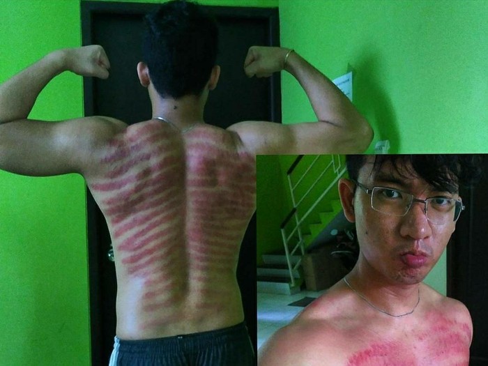 Detail Gambar Kerokan Badan Nomer 17