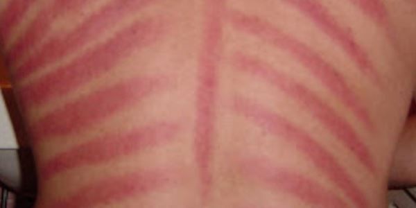 Detail Gambar Kerokan Badan Nomer 21