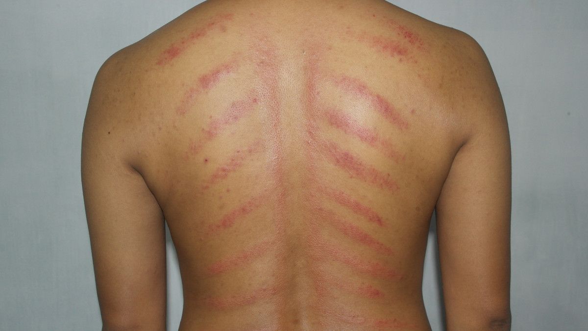 Detail Gambar Kerokan Badan Nomer 3