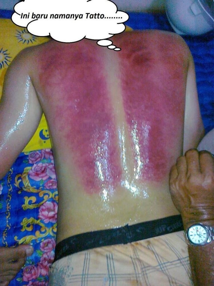 Detail Gambar Kerokan Badan Nomer 31