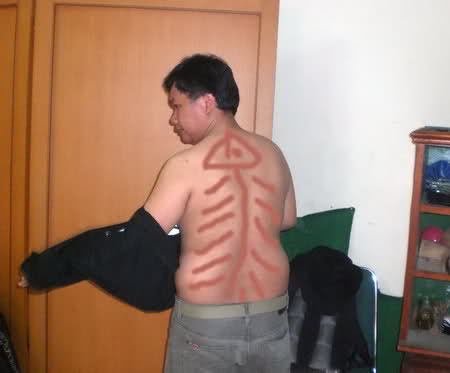 Detail Gambar Kerokan Badan Nomer 32