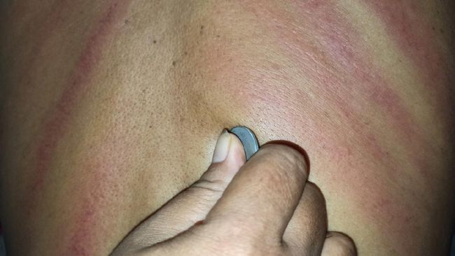 Detail Gambar Kerokan Badan Nomer 39