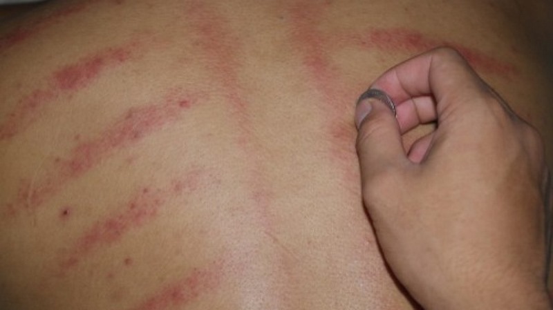 Detail Gambar Kerokan Badan Nomer 40