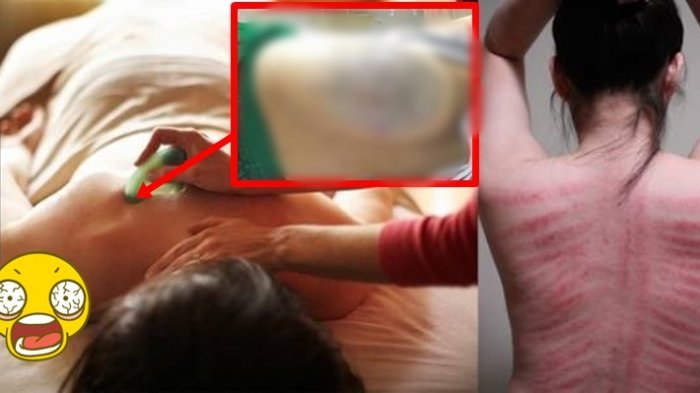 Detail Gambar Kerokan Badan Nomer 42