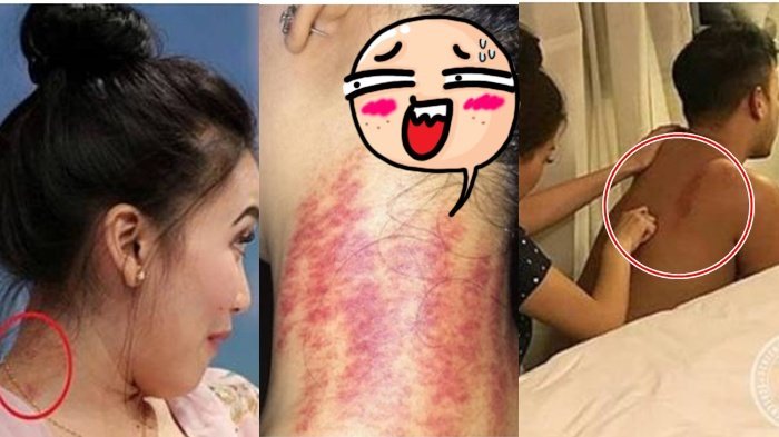 Detail Gambar Kerokan Badan Nomer 45