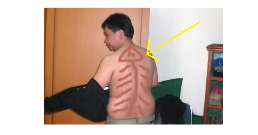 Detail Gambar Kerokan Badan Nomer 49