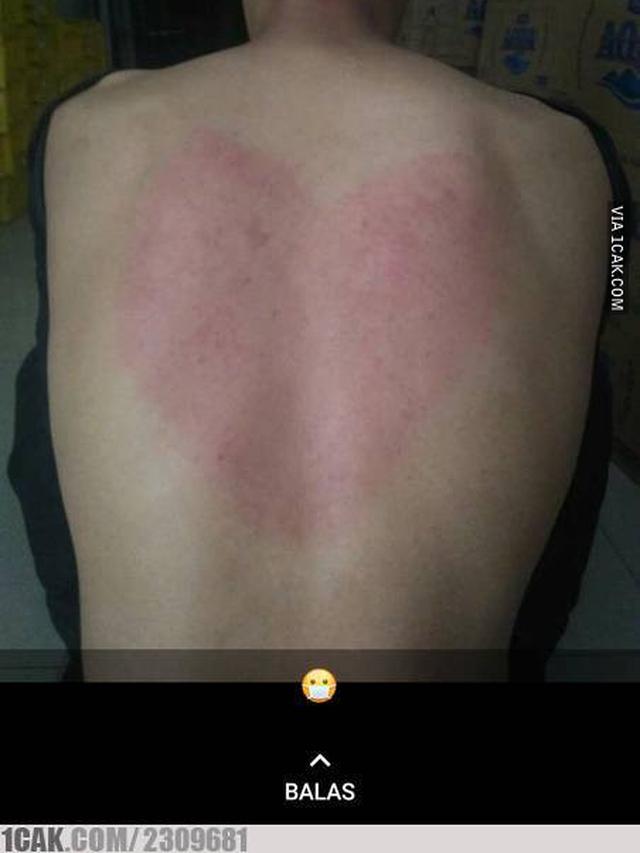 Detail Gambar Kerokan Badan Nomer 50
