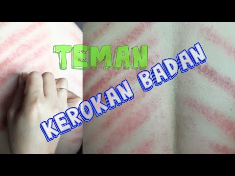 Detail Gambar Kerokan Badan Nomer 52