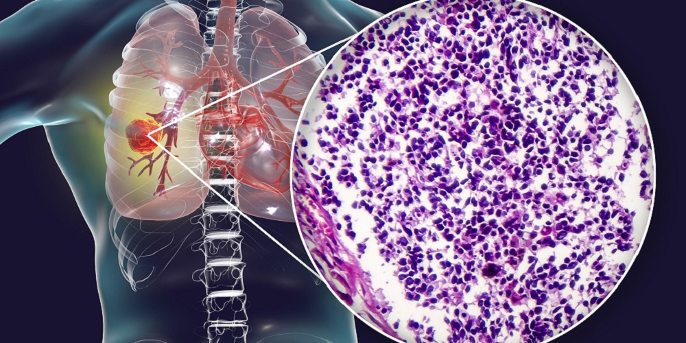 Detail Contoh Penyakit Tidak Menular Nomer 33