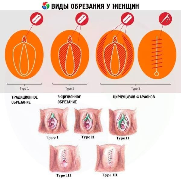 Detail Gambar Khitan Wanita Nomer 18