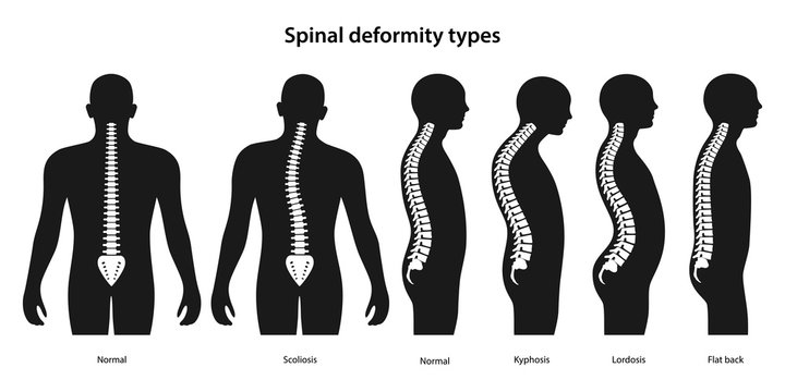 Detail Gambar Kifosis Lordosis Skoliosis Nomer 21