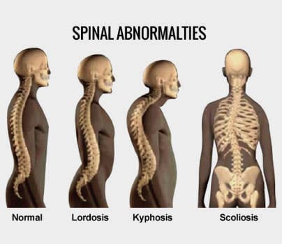 Detail Gambar Kifosis Lordosis Skoliosis Nomer 4