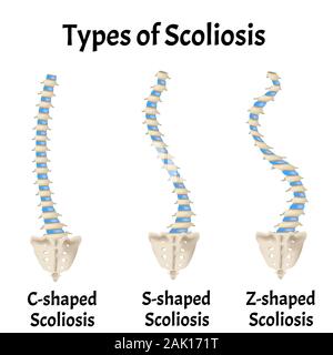 Detail Gambar Kifosis Lordosis Skoliosis Nomer 43