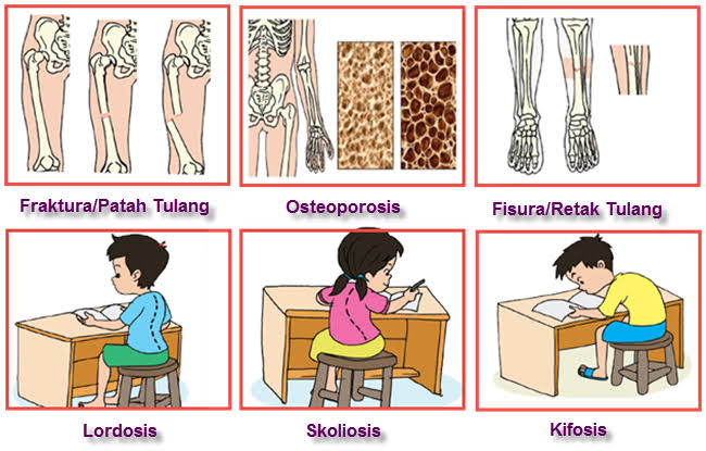 Detail Gambar Kifosis Lordosis Skoliosis Nomer 57