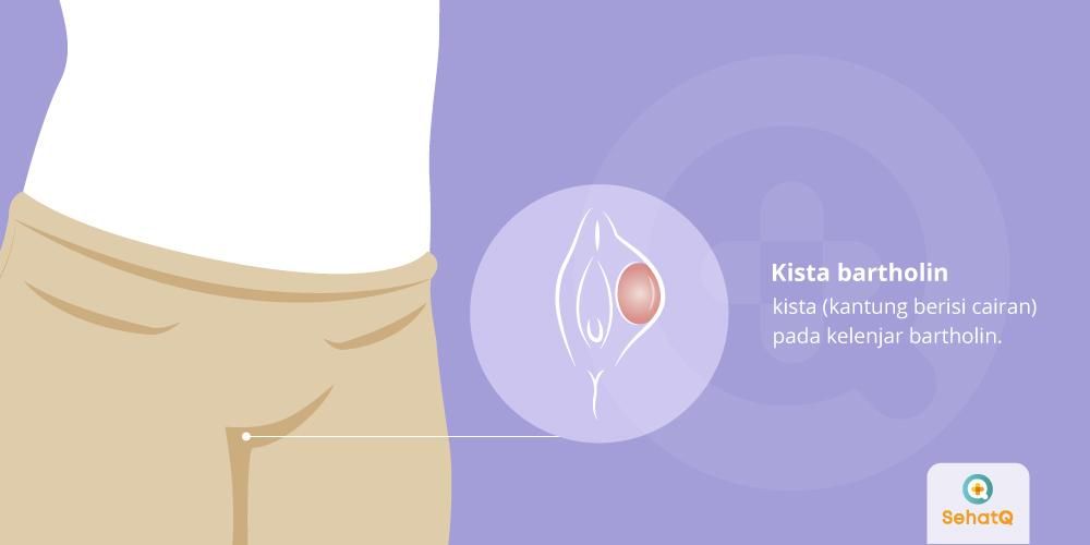 Detail Gambar Kista Bartholin Nomer 10