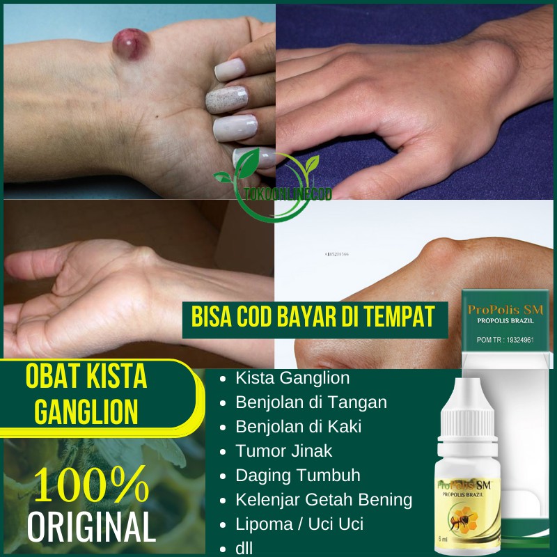 Detail Gambar Kista Ganglion Nomer 42