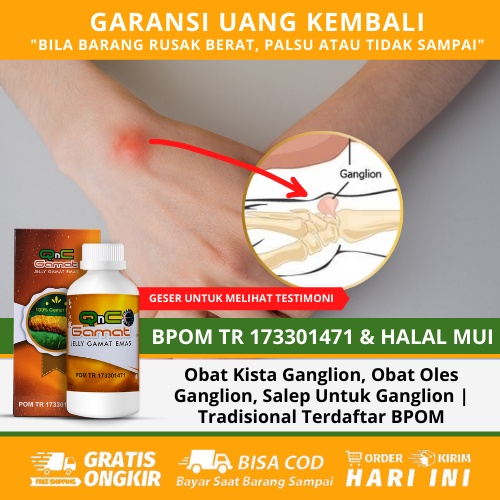 Detail Gambar Kista Ganglion Nomer 48