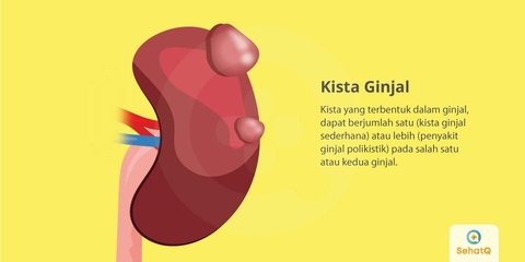 Detail Gambar Kista Ginjal Nomer 2