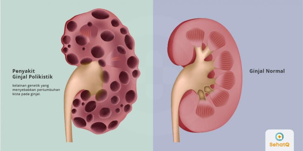 Detail Gambar Kista Ginjal Nomer 16