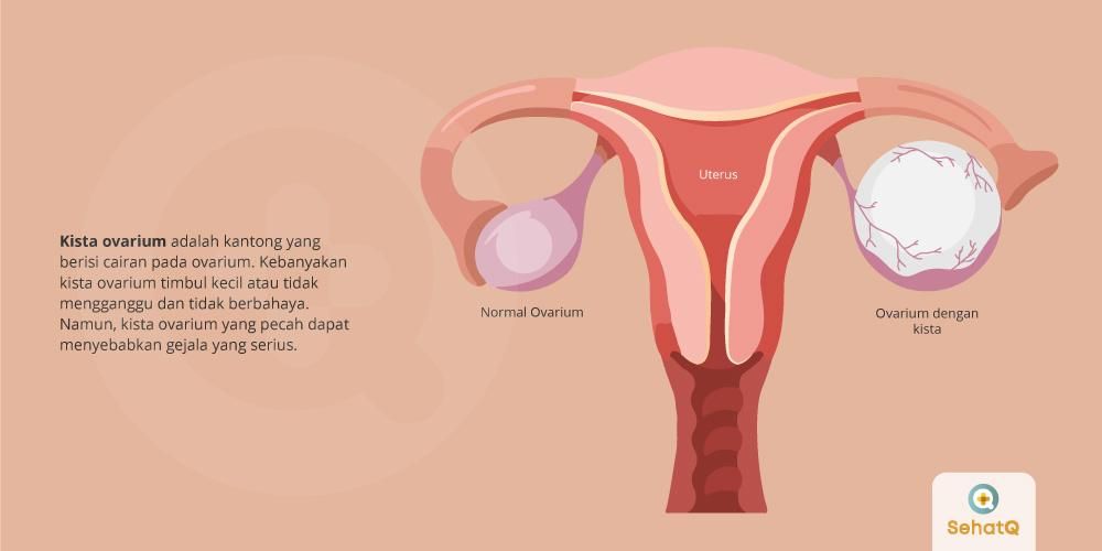 Detail Gambar Kista Ovarium Nomer 3