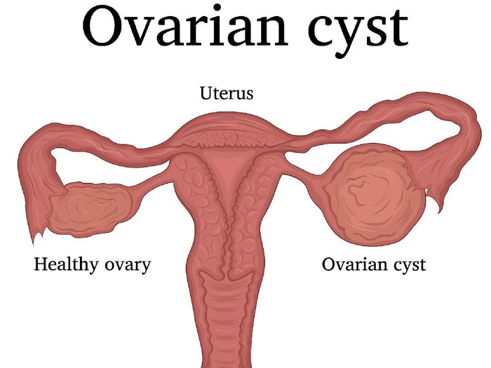 Detail Gambar Kista Ovarium Nomer 4