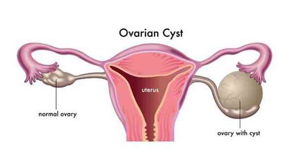 Detail Gambar Kista Ovarium Nomer 8